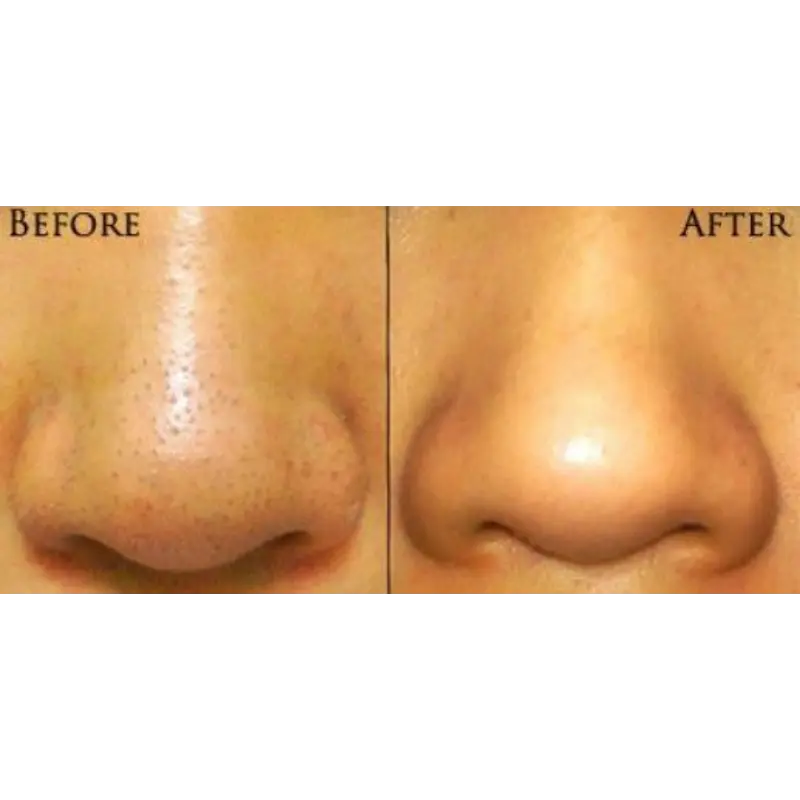 PoreVacuum™ Pore Cleanser & Blackhead Remover - Image 2